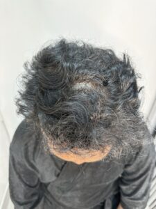 aditia-after-1000-graft