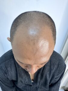 danang-before-3000-graft Large