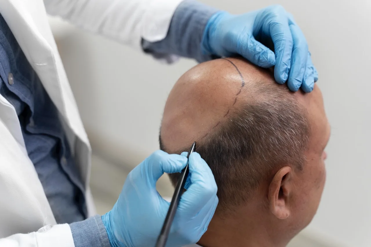 apa-itu-dhi-solusi-presisi-untuk-transplantasi-rambut-lebih-alami