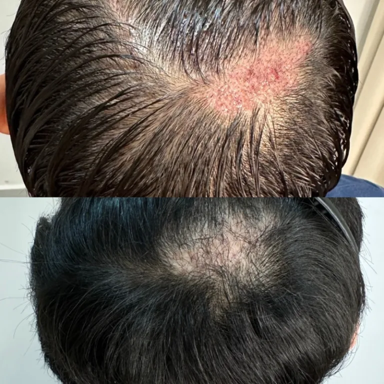 Hasil hair transplant FUE di Jakarta setelah 3 bulan - Agra