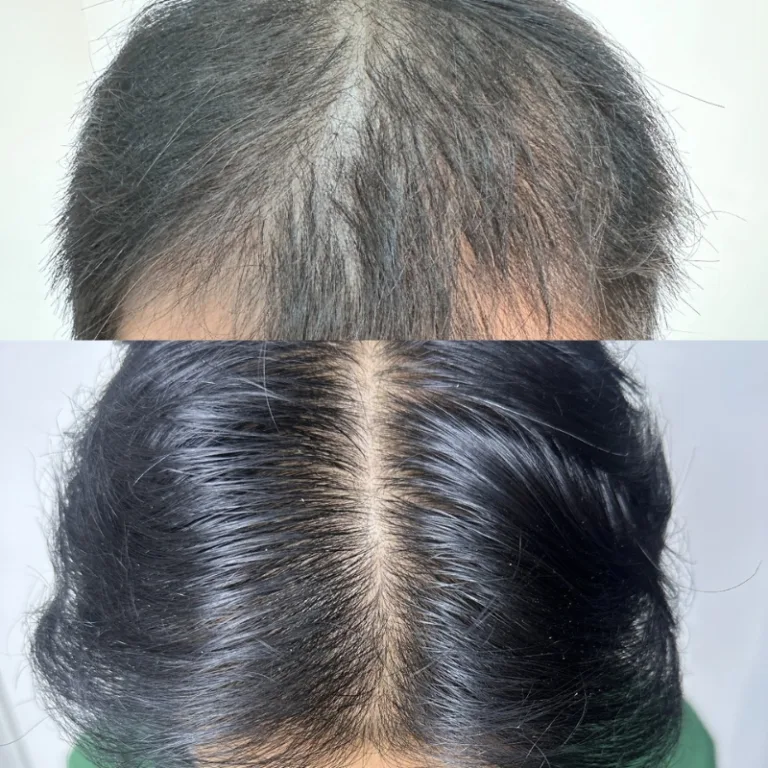 Hasil hair transplant FUE di Jakarta setelah 6 bulan - Agus