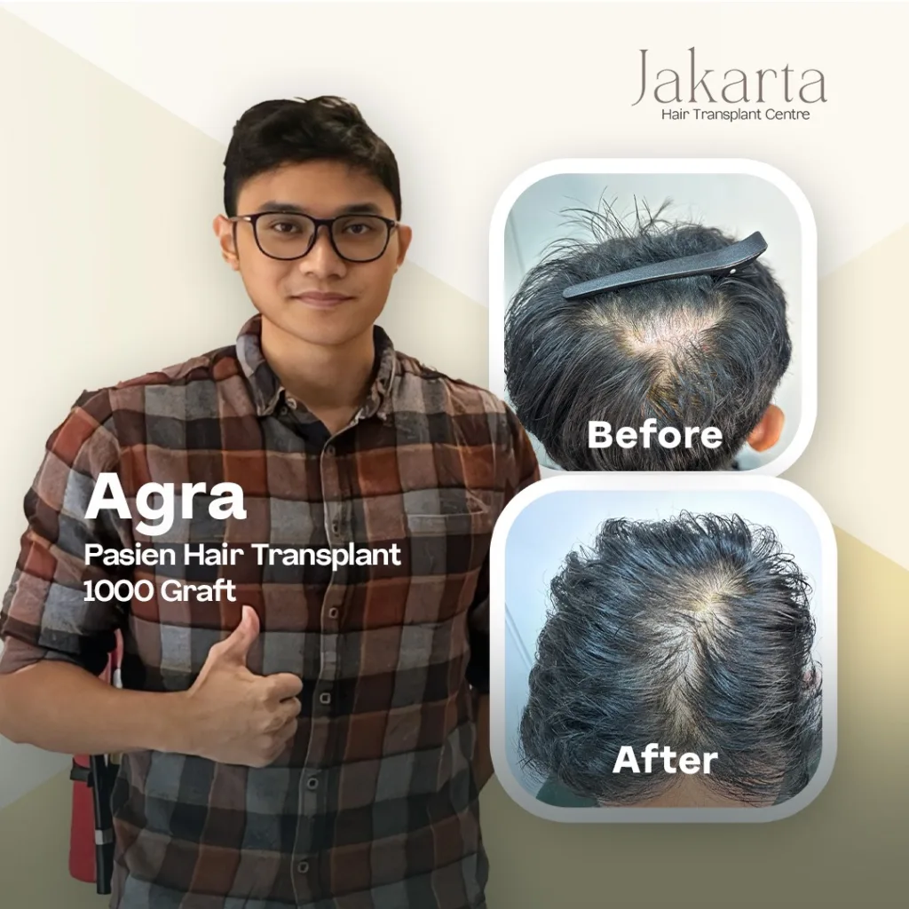 Before After Agra – Hasil Hair Transplant Jakarta di Jakarta Hair Transplant Centre