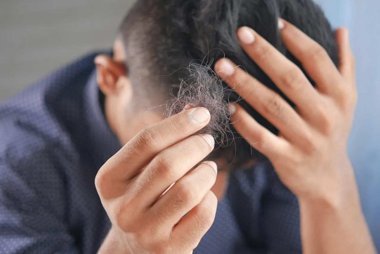 Cara Ampuh Mengatasi Rambut Rontok dan Mencegah Kebotakan